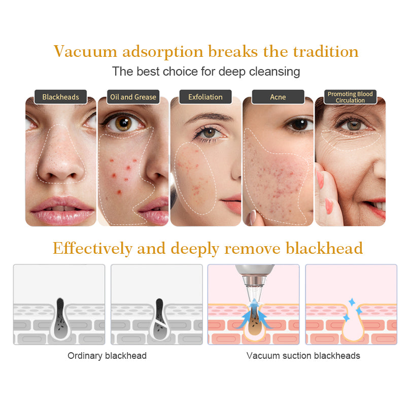 Blackhead Remover Vacuum Equipped with 5 Tips